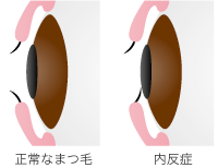 内反症